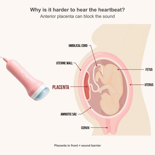Anterior placenta diagram with fetal doppler probe showing how placenta blocks heartbeat detection