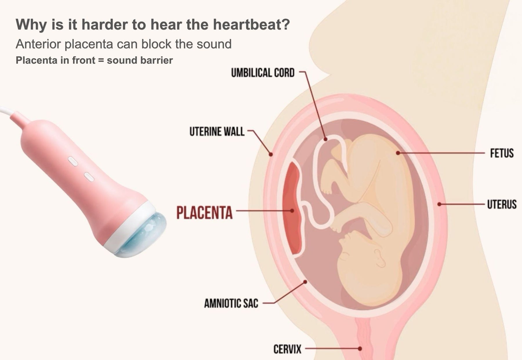 Anterior placenta diagram with fetal doppler probe showing how placenta blocks heartbeat detection