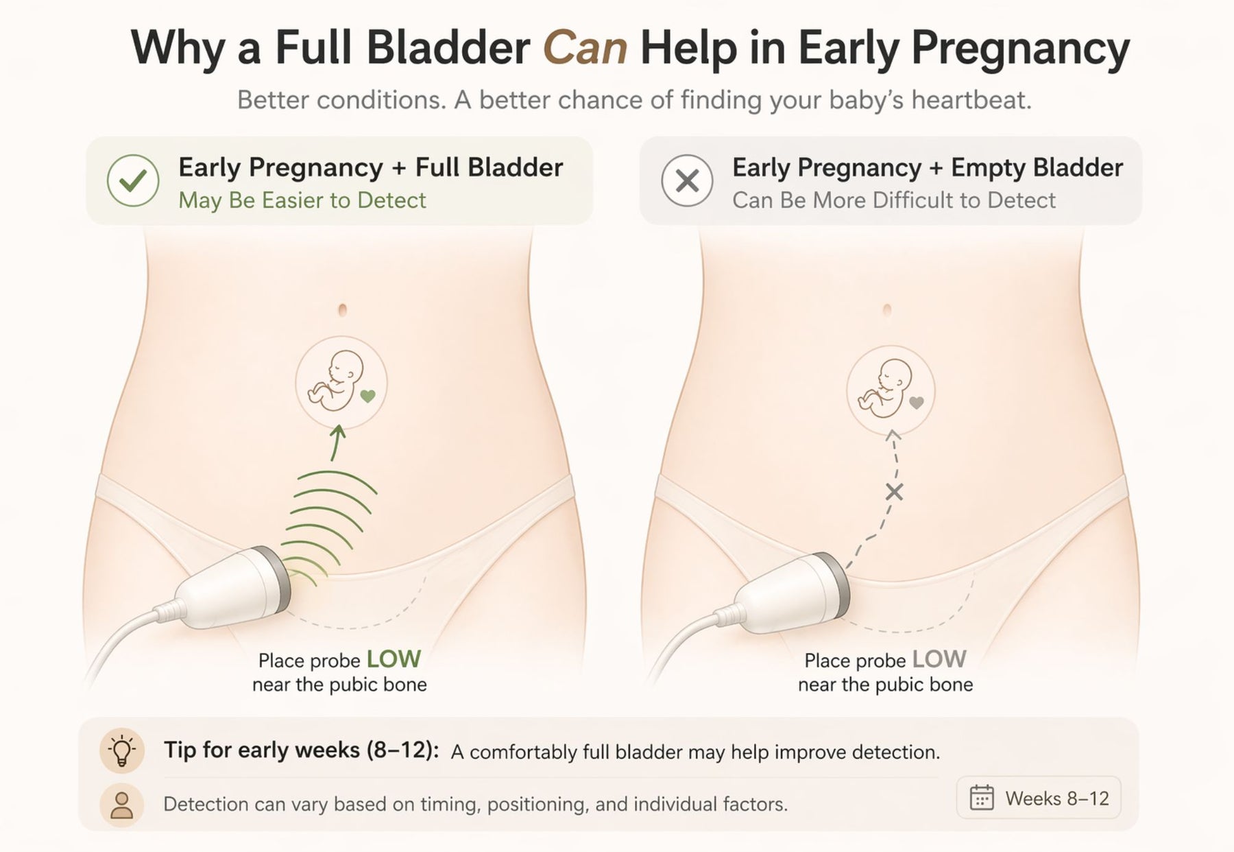 Diagram showing how a full bladder assists at-home fetal doppler detection in early pregnancy